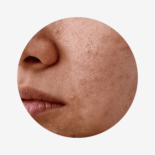 Acne prone - beautybuddy.nl