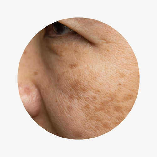 Hyperpigmentation - beautybuddy.nl